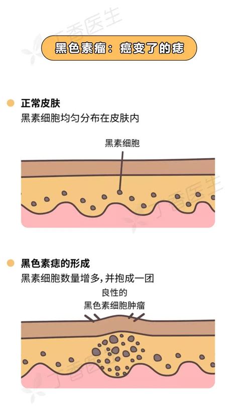 痣太多|痣也可能会癌变！长在 3 个地方要注意